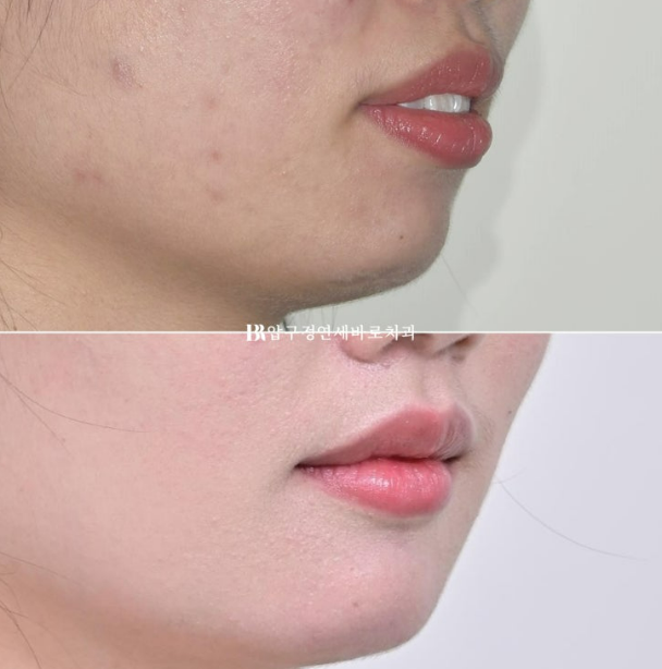 How Do the Buccal Corridors and Smile Line Change After Extraction Treatment for Protruding Teeth?|An Orthodontic Case That Also Improved Lip Incompetence image 15