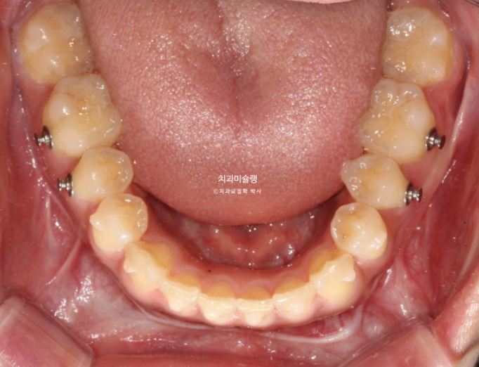 선수술 양악수술 비대칭 주걱턱 잇몸미소 치료 인비절라인 라이트 관련 이미지 10