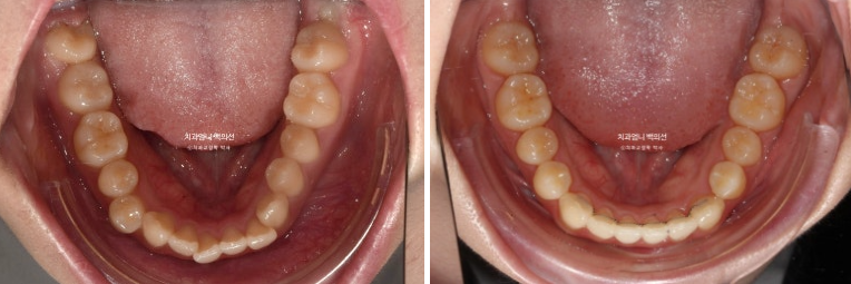 인비절라인 교정 비발치 비대칭 덧니 중심선 선천적 결손치 교정? 관련 이미지 17