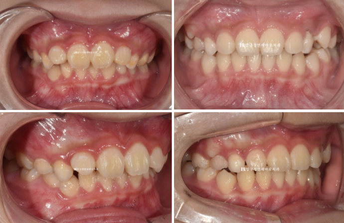 어린이교정 투명교정 인비절라인 퍼스트 후기 관련 이미지 3