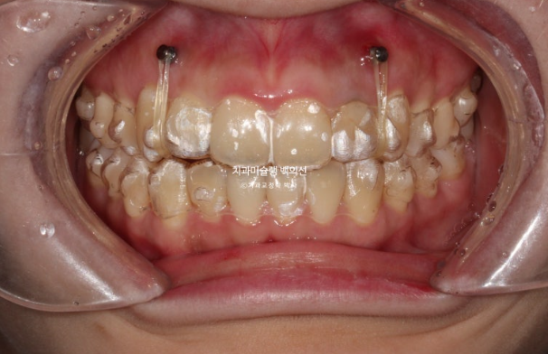 잇몸미소 인비절라인 거미스마일 토끼이빨 교정 무삭제 라미네이트 반대교합 치료 후기 관련 이미지 6