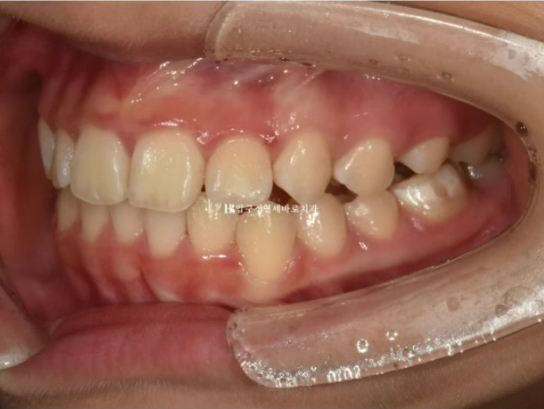 어린이 투명교정 인비절라인 틴 덧니 교정 후기 관련 이미지 6