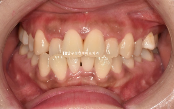 Invisalign Success Depends on Wearing Them Consistently|9-Month Real Treatment Case of Crowding & Underbite image 2