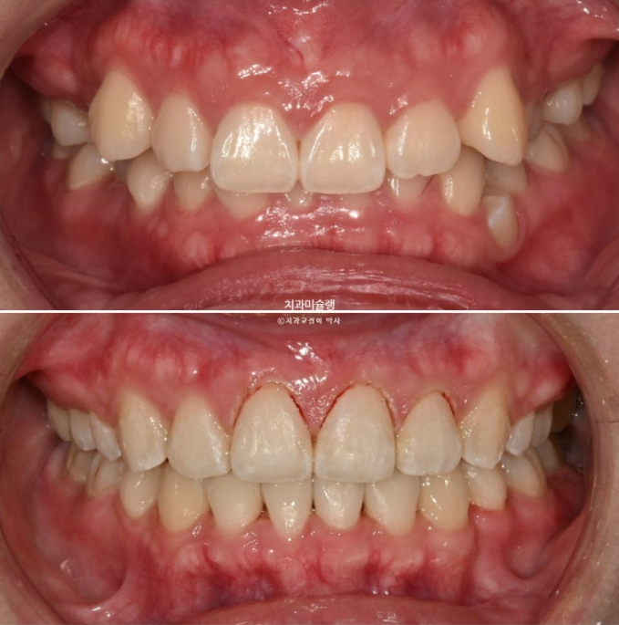잇몸미소 거미스마일 치료 옥니 교정 잇몸성형 후기 관련 이미지 17