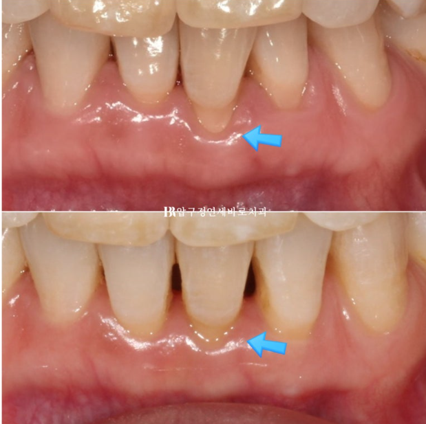 50대 치아교정 인비절라인 라이트 앞니교정 치료 후기 관련 이미지 14
