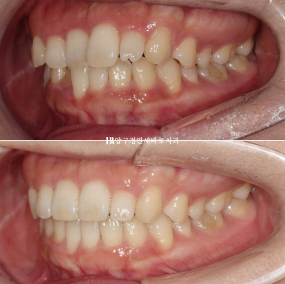 앞니부분교정 기간? MTA 미니튜브 교정 반대교합 교정 관련 이미지 12
