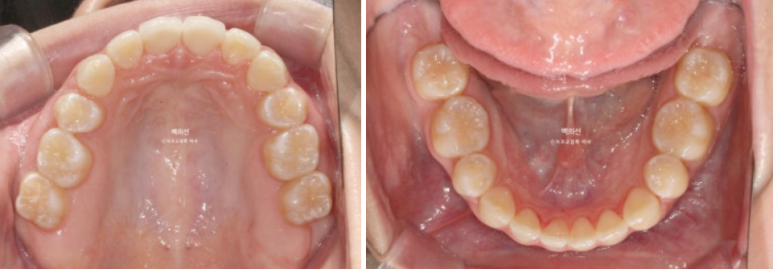 클리피씨 교정에서 인비절라인 변경 마무리 인비절라인 라이트 치료기간 4개월 관련 이미지 6