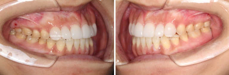 비수술 개방교합 클리피씨 30대 무삭제 라미네이트 치료기간 2년 관련 이미지 14