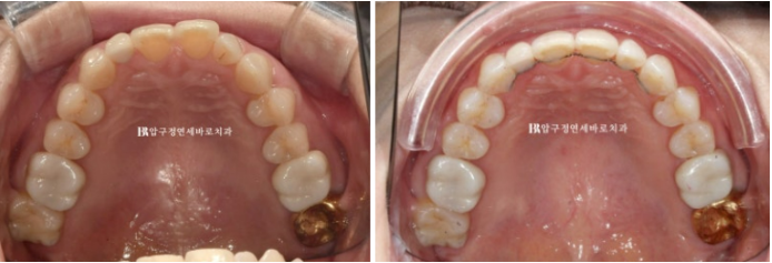 Invisalign Lite for Orthodontic Treatment in Your 40s: Crossbite and Protrusive Mouth Correction image 15