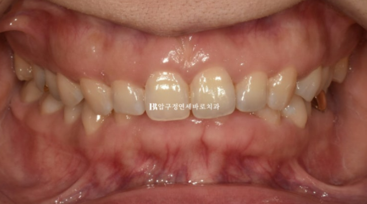 인비절라인 캔팅 교정 과개교합 교정 임플란트 재교정 관련 이미지 2