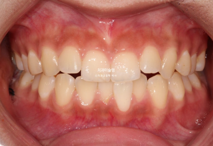 유학생 치아교정 해외거주 한국에서 치아교정? 관련 이미지 2