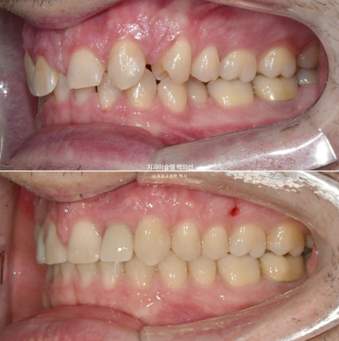 앞니 선천적 결손 인비절라인 임플란트 과개교합 치료 기간 관련 이미지 27