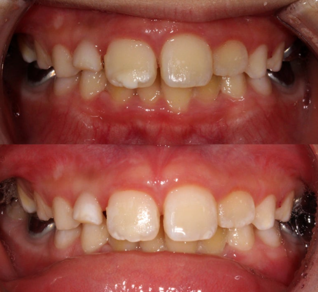 치아 흰색 얼룩 ? 갈아내지 않고 치료하는 법 관련 이미지 6