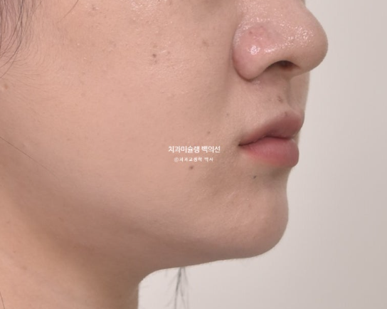 앞니 벌어짐 합죽이 방지 교정 기간 1년 4개월 관련 이미지 5