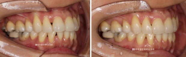 블랙트라이앵글 없애는 교정 가능할까요? 재교정 단기교정 후기 관련 이미지 8