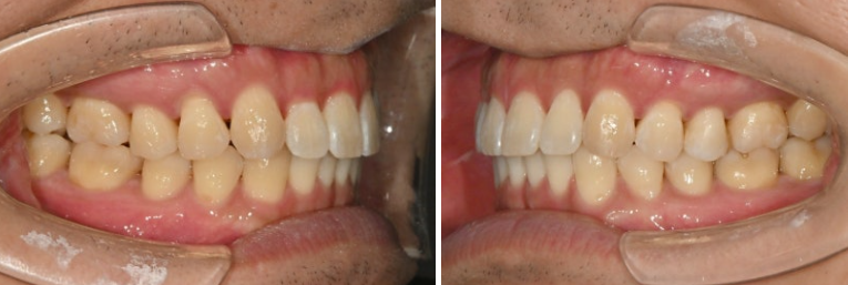 가위교합 벌어짐 중심선 과개교합 인비절라인 라이트 교정 관련 이미지 13