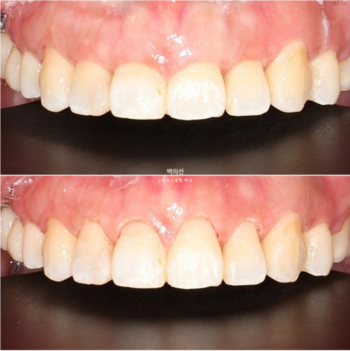 거미스마일 교정 돌출입 발치교정 입술부전 호두턱 치료기간 2년반 관련 이미지 15