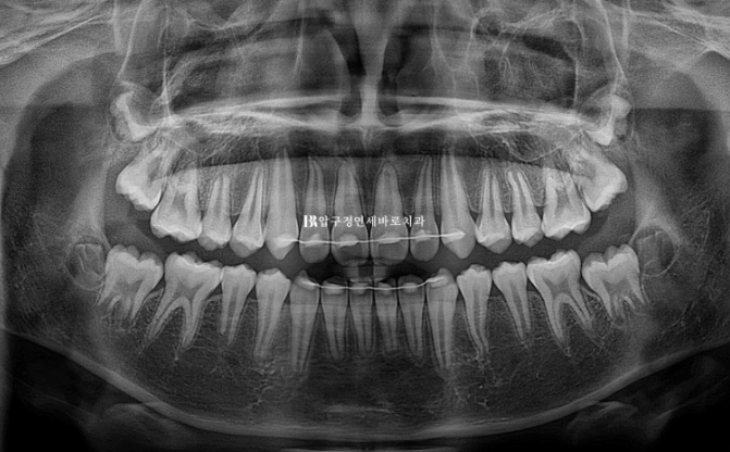 Pediatric Clear Aligners That Improved Both Deep Bite and Protruding Teeth image 19