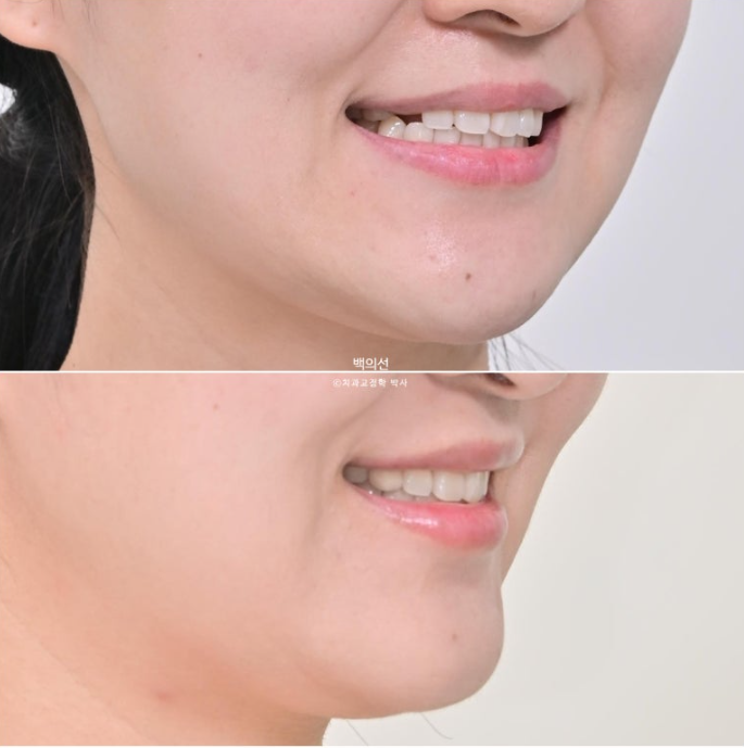 매복 결손 잔존유치 라미네이트 크라운 캔팅 인비절라인 라이트 치료 관련 이미지 21