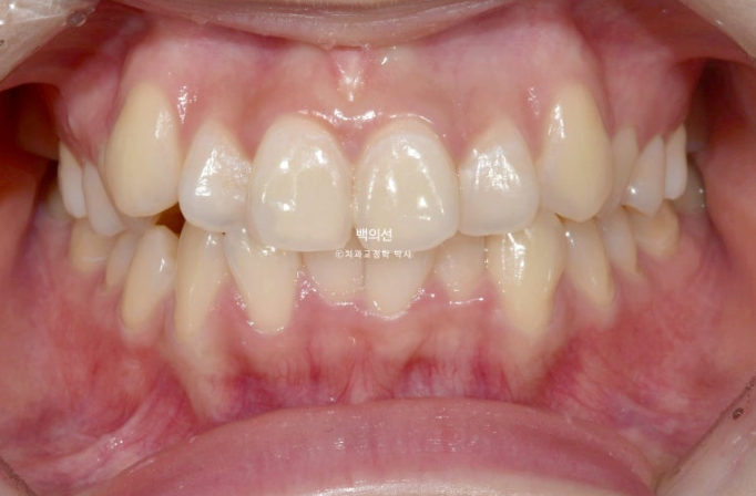 비발치 덧니교정 인비절라인 교정 사랑니 이용 교정 관련 이미지 2