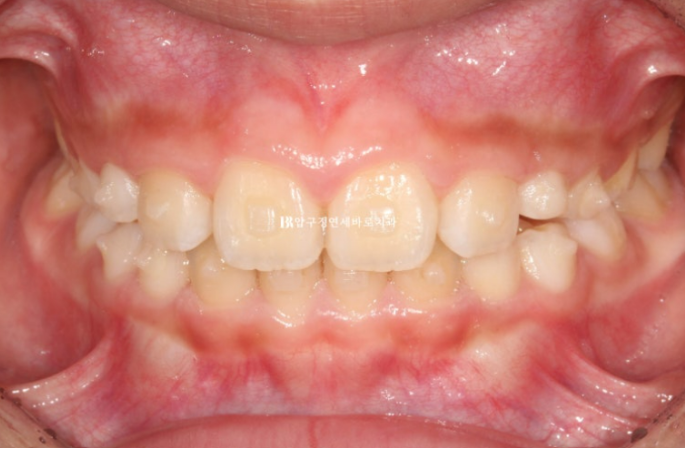 무턱교정 어린이 투명교정 인비절라인 퍼스트 교정 후기 관련 이미지 13