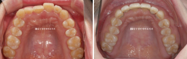 앞니부분교정 기간? MTA 미니튜브 교정 반대교합 교정 관련 이미지 6
