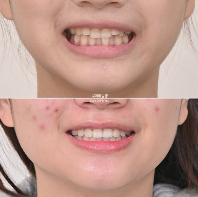 유학생 치아교정 해외거주 한국에서 치아교정? 관련 이미지 19