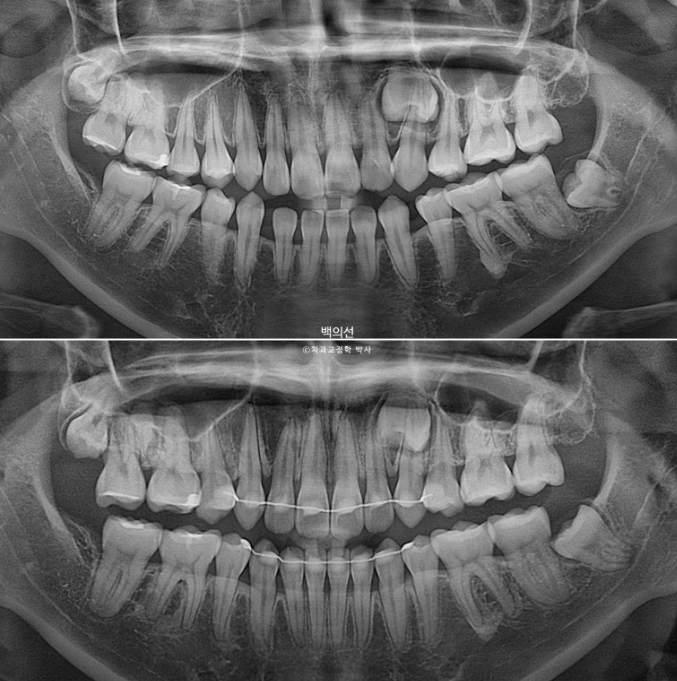 돌출입 교정 인비절라인 발치 교정 개방교합 치료 후기 관련 이미지 29