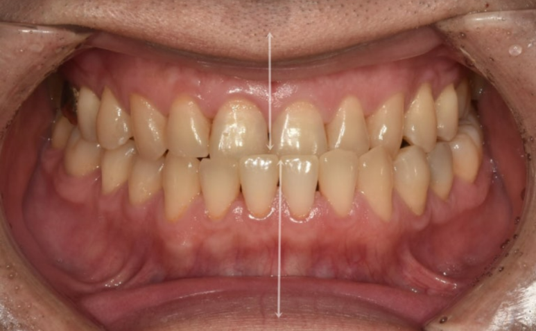 40대 인비절라인 비수술 비발치 주걱턱 비대칭 교정 관련 이미지 2