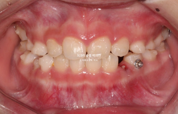 어린이 비대칭 반대교합 주걱턱 인비절라인 퍼스트 프리올소 성장 교정 관련 이미지 16