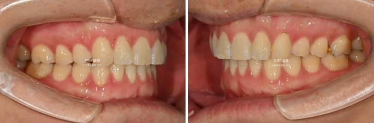 덧니 앞니 부분교정 급속교정 단기 MTA 미니튜브 기간 6개월 관련 이미지 10