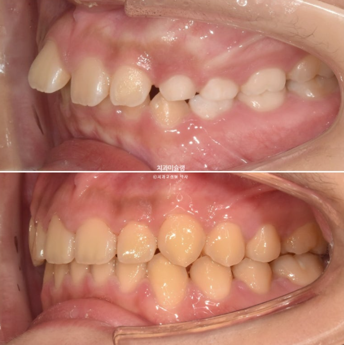 선천적 결손 잔존유치 과개교합 돌출입 인비절라인 퍼스트 어린이 투명교정 치료기간 관련 이미지 20