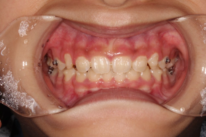 Pediatric Clear Aligners That Improved Both Deep Bite and Protruding Teeth image 10