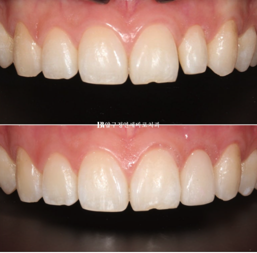 앞니 부분교정은 어떤 경우에 가능한가요? 단기 앞니 부분교정 왜소치 치료 무삭제 라미네이트 관련 이미지 8