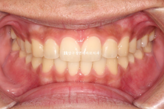 인비절라인 라이트 교정 덧니 이소맹출 반대교합 관련 이미지 9