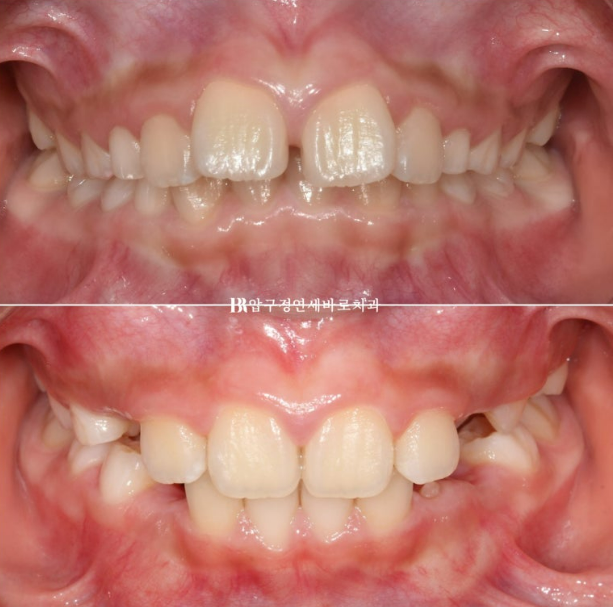Invisalign First Correction for a Retruded Chin in a Child Orthodontic Treatment for Protrusion image 21