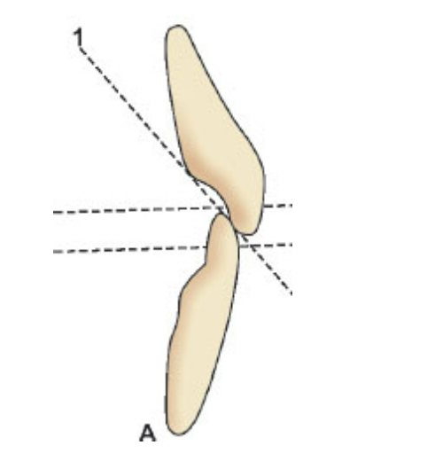 50대 라미네이트 삭제 없이 하는 법? 관련 이미지 4