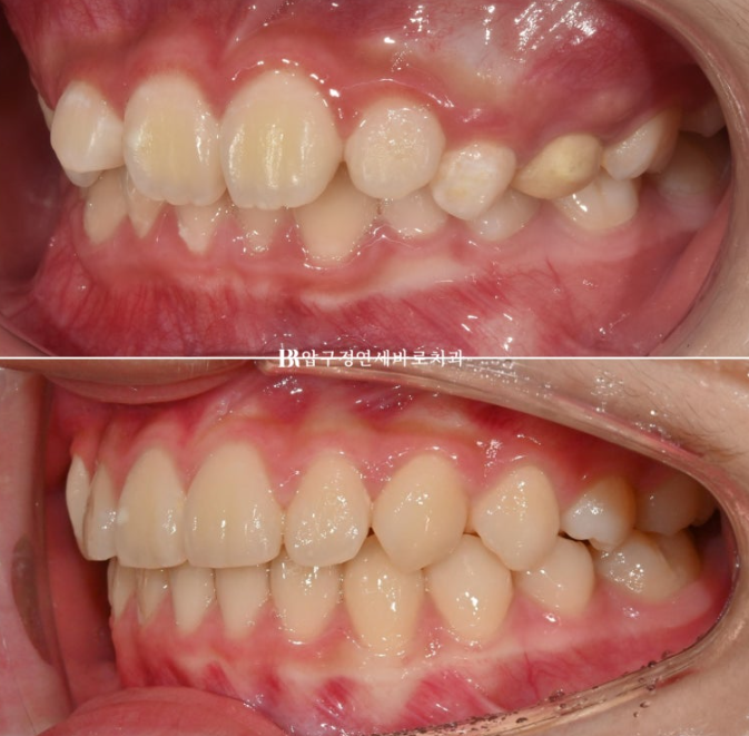 어린이교정 투명교정 인비절라인 퍼스트 후기 관련 이미지 16
