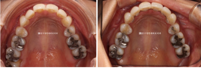 How Can Black Triangles Be Removed? Is Re-treatment Orthodontics an Option? image 9