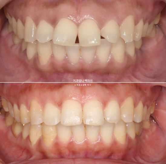40대 인비절라인 라이트 앞니 벌어짐 뻗침 돌출 치료 관련 이미지 15