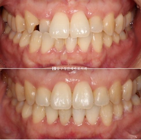 토끼이빨 치아교정 ? 토끼이빨 교정 치료기간은 어떻게 되나요? 관련 이미지 1