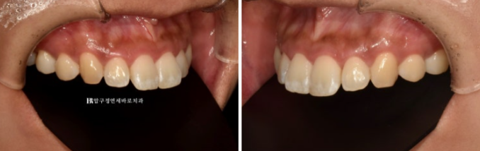 치아 흰 반점, 갈지 않고 치료할 수 있을까요? 아이콘(Resin Infiltration) 실제 사례 관련 이미지 1