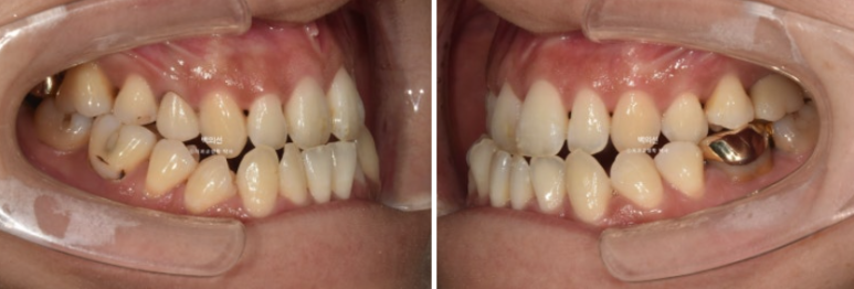 30대 비수술 비발치 주걱턱 부정교합 인비절라인 교정 관련 이미지 3