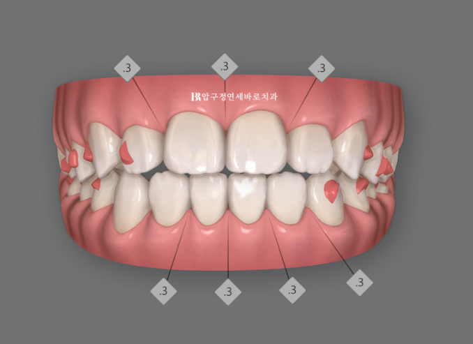 인비절라인 라이트 과개교합 반대교합 돌출입 뻐드렁니 교정 치료 관련 이미지 9