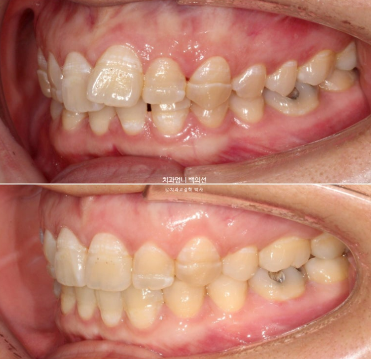 30대 교정 돌출입 교정 덧니 발치교정 치료기간 1년 8개월 관련 이미지 14