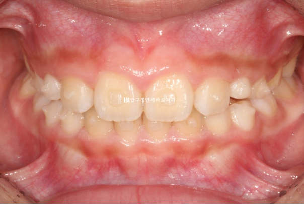 Invisalign First Correction for a Retruded Chin in a Child Orthodontic Treatment for Protrusion image 13