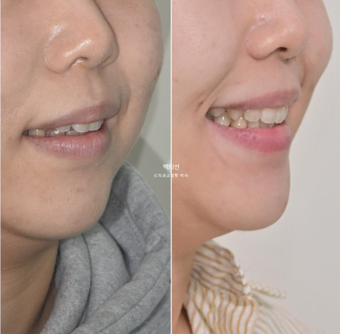 돌출입 교정 인비절라인 발치 교정 개방교합 치료 후기 관련 이미지 1