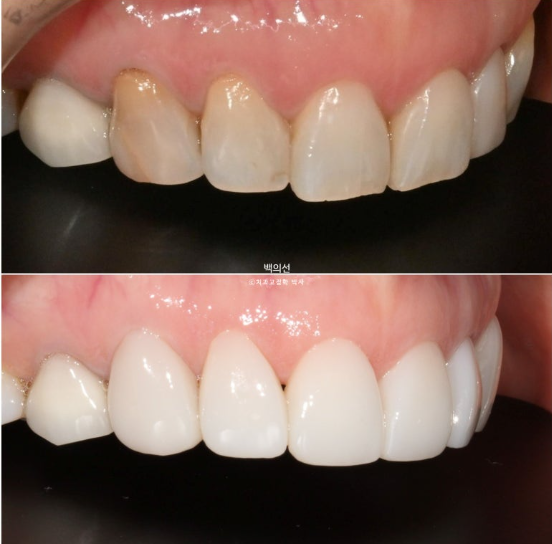 40대 무삭제 라미네이트 블랙트라이앵글 레진 치료 관련 이미지 8
