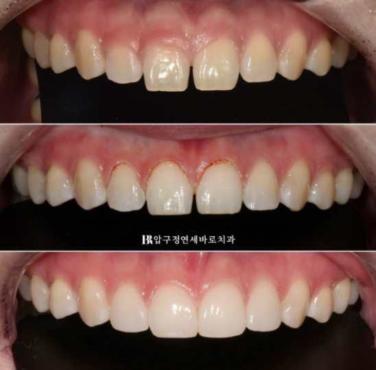 왜소치·원추형 치아, 교정보다 무삭제 라미네이트가 좋은 이유 | 앞니 벌어짐 치료 후기 관련 이미지 11