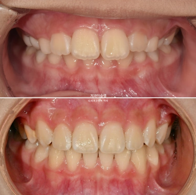 어린이 돌출입 교정 무턱 투명교정 인비절라인 퍼스트 관련 이미지 19